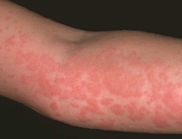 Аллергия на Парацетамол у взрослого