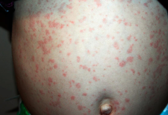 Аллергия на Парацетамол у взрослого