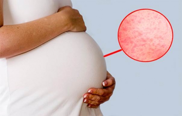 Чем опасна краснуха при беременности