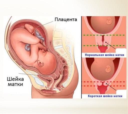 Что такое пессарий для беременных