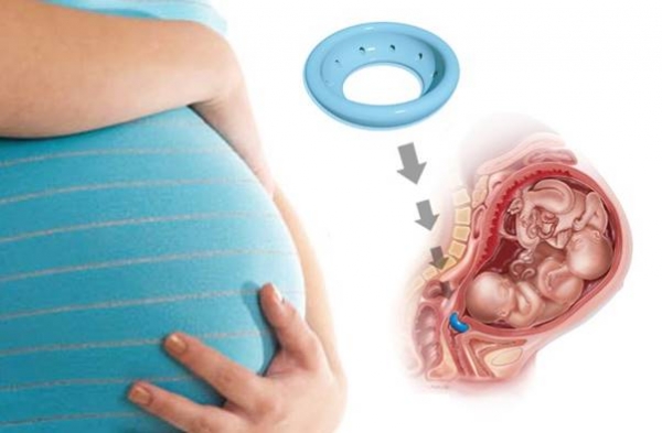 Что такое пессарий для беременных