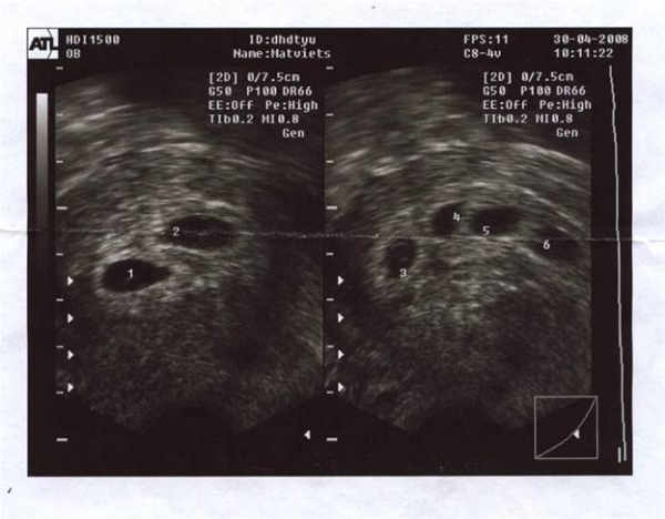 Узи после криопереноса. Эмбрион на первом УЗИ после эко. УЗИ после переноса эмбрионов.