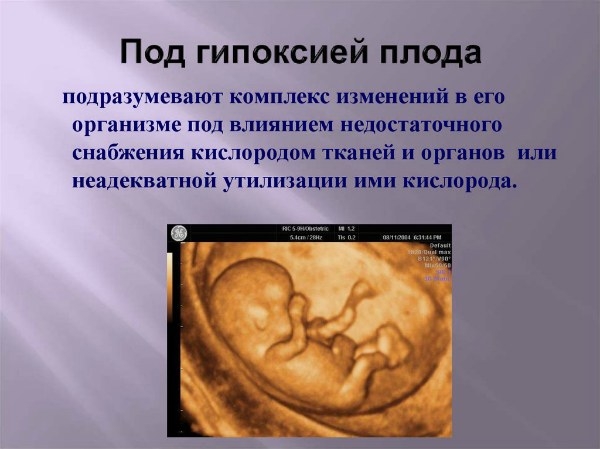 Гипоксия плода при беременности
