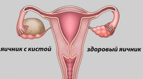 Киста яичника во время беременности