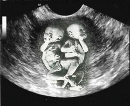 Особенности беременности двойней