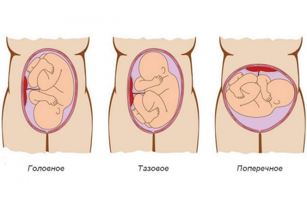 Особенности беременности двойней
