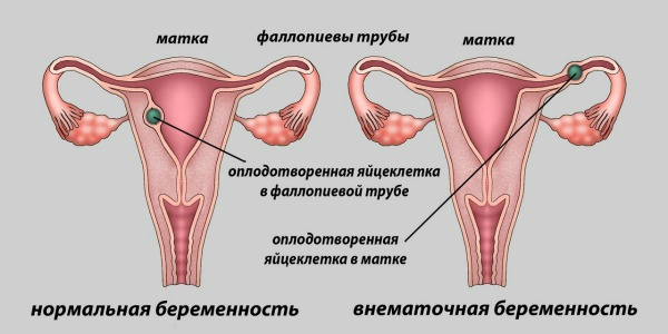Причины боли в левом боку внизу живота при беременности